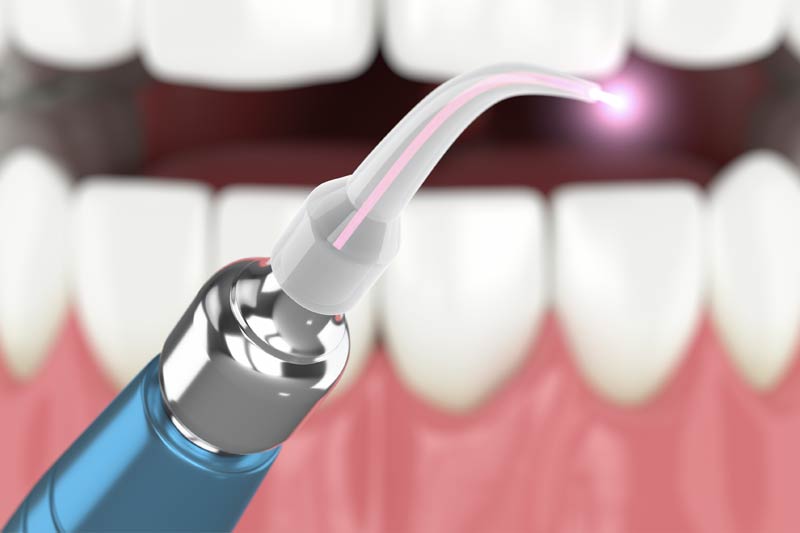 Laser Dentistry in Las Vegas