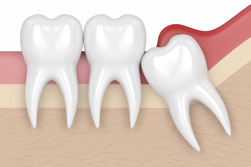 Wisdom Tooth Removal in Las Vegas